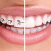 ¿Invisalign o brackets? ¿Qué ortodoncia ofrece mejores resultados?