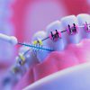¿Qué cuidados debe seguir una persona con ortodoncia?